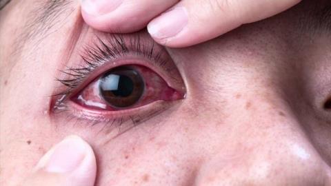 Trachoma: Symptoms, causes and treatment