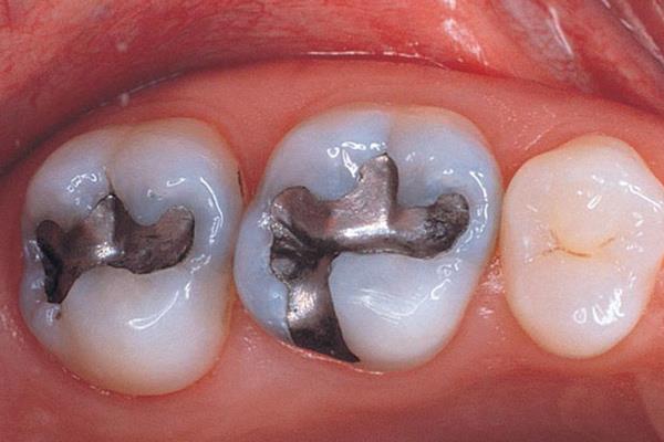 Зубные пломбы и что нужно знать