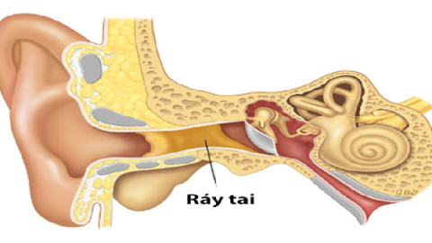 Earwax blockage and how to prevent it