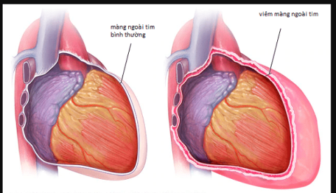 Dressler syndrome: ภาวะแทรกซ้อนหลังจากหัวใจถูกทำลายและสิ่งที่คุณต้องรู้
