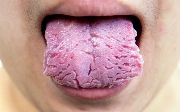 Why do I have cracks on my tongue?