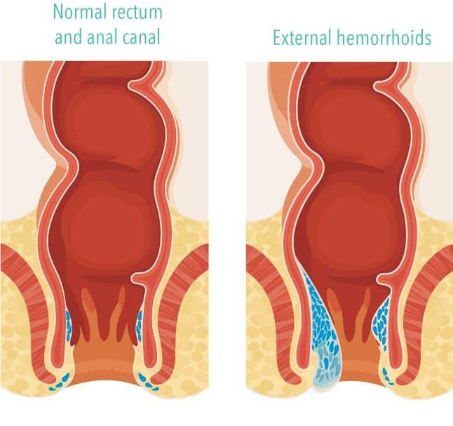 Is it dangerous to have hemorrhoids during pregnancy?