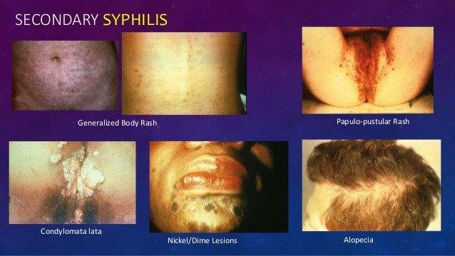 The stages of syphilis not everyone knows!