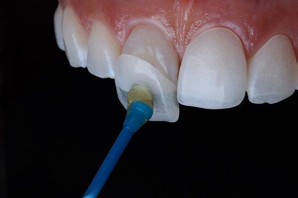 Cos'è l'impiallacciatura di porcellana?  Hai bisogno di affilare i denti?