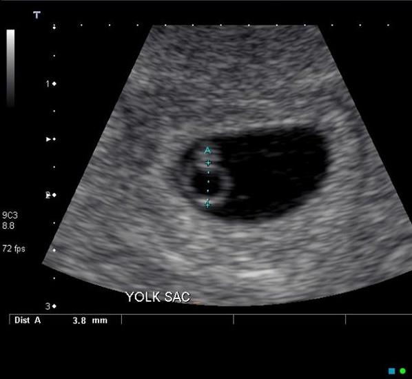 The image of yolksac on ultrasound and what mothers need to know