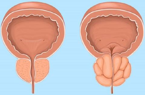 Prostate disease and related information