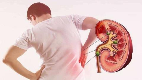Renal colic – a pain that cannot be ignored