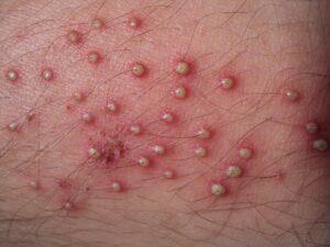 Folliculitis: Things You Cant Ignore