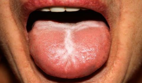 Cosa dicono le malattie della lingua sulla tua salute?