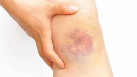 Unusual bruises warn of dangerous diseases you should know!