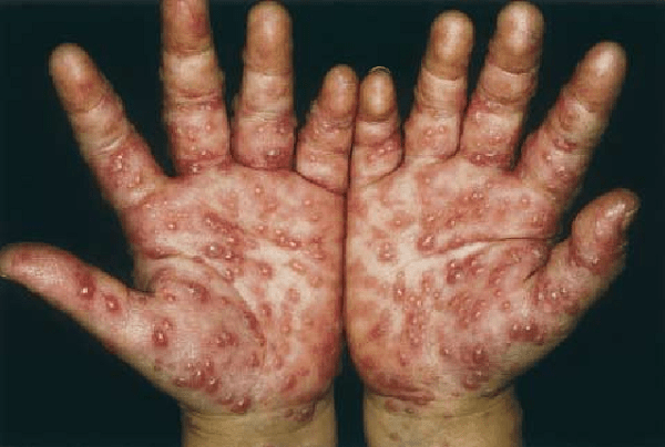 What is the difference between smallpox and chickenpox?
