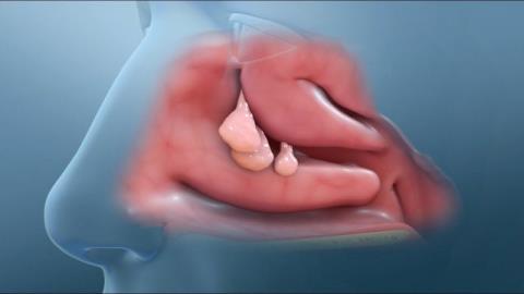Nasal polyps: What are the treatments? When do I need surgery?