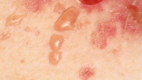 Is pemphigus (autoimmune blisters) dangerous?