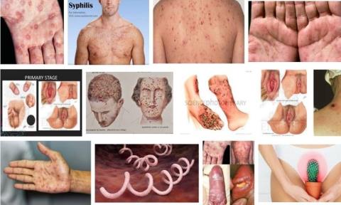 The stages of syphilis not everyone knows!