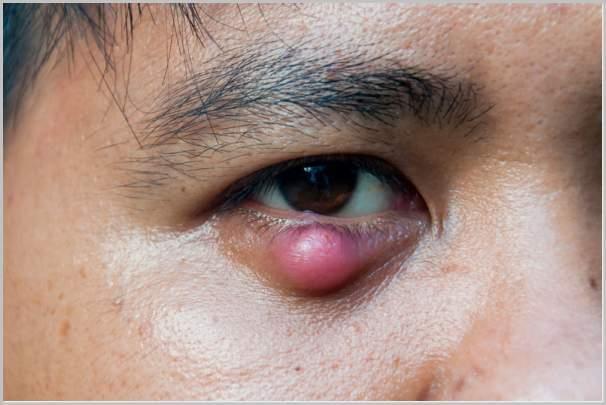 Eye styes: Causes, symptoms and treatment