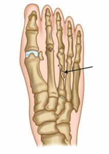 Foot fracture: Basic knowledge to know