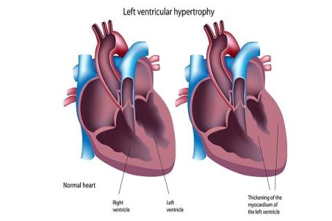 Ipertrofia ventricolare sinistra: cause, sintomi, diagnosi e trattamento