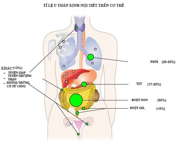 Neuro-endocriene tumoren: een groep kankers die gemakkelijk over het hoofd wordt gezien