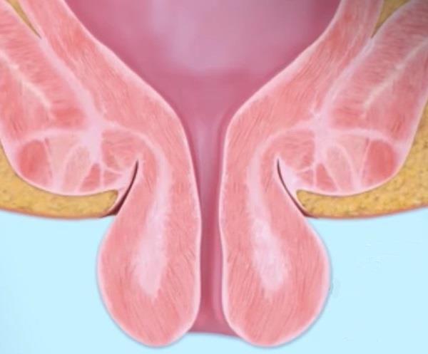 Síndrome de úlcera rectal aislada: signos, causas, diagnóstico y tratamiento