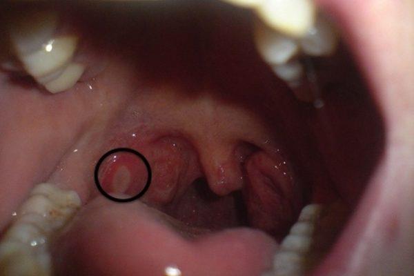 Úlceras en la garganta y cosas que debe saber