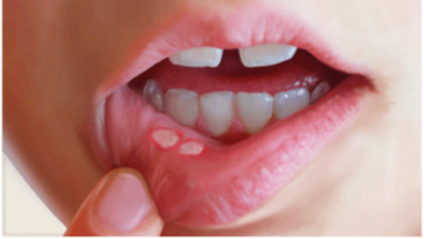 兒童口腔潰瘍：這是一種常見病嗎？