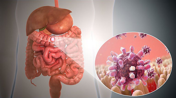 腸間膜リンパ節炎：原因、症状および治療