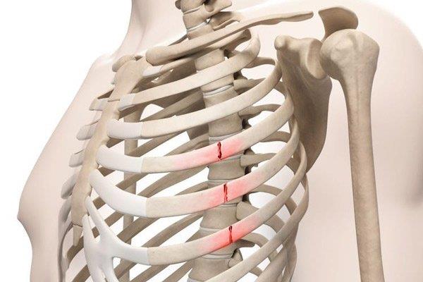How are rib fractures treated?  How to care and recover?