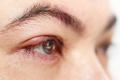 Swollen eyes: What you need to know and how to prevent it
