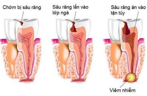 Inflamación de la pulpa dental: Causas, diagnóstico y tratamiento