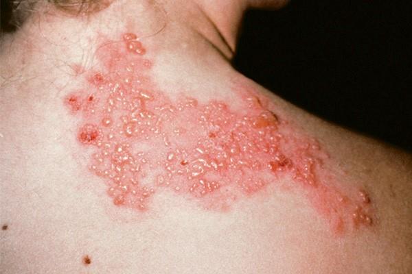 Herpes zóster: causas, síntomas y diagnóstico