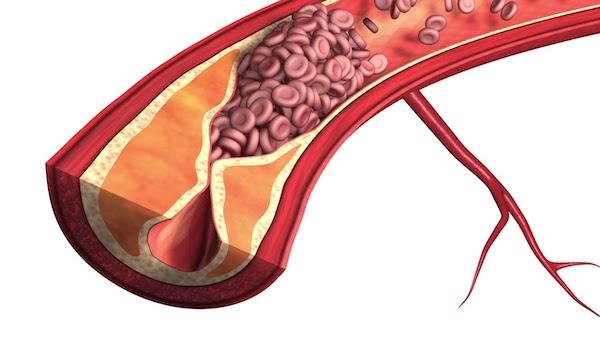 Isquemia intestinal: ¡lo que debes saber!