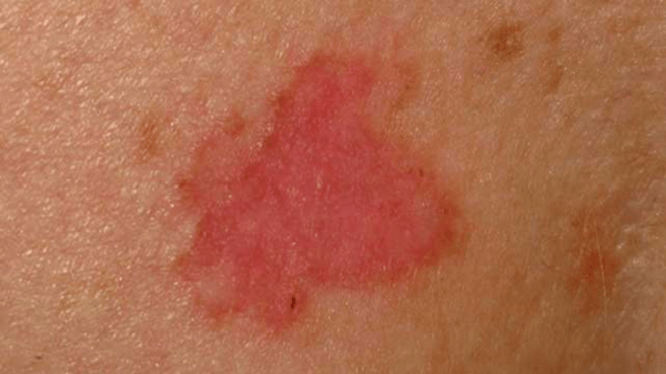 Behandeling van niet-melanoom huidkanker – wat u moet weten