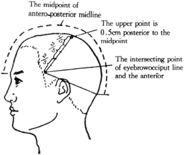 Ubati kelewatan pertuturan dengan akupunktur, mendedahkan rahsia
