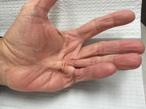 Dupuytren contracture and what you need to know