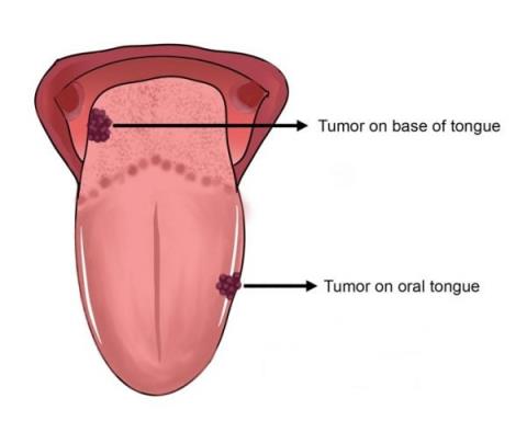 Cancro alla lingua: è curabile?