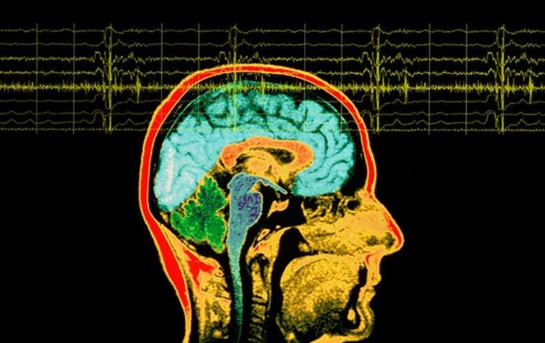 Ce știi despre epilepsia lobului temporal?