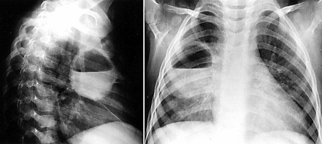 Abscesso pulmonar: conhecimento básico que você precisa saber
