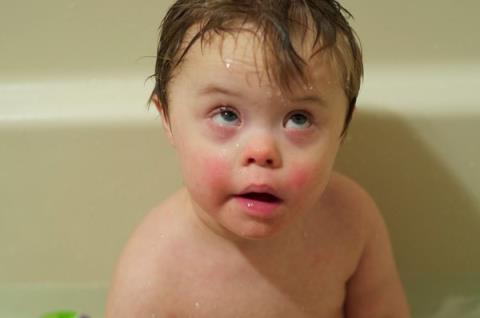 What is Down syndrome?