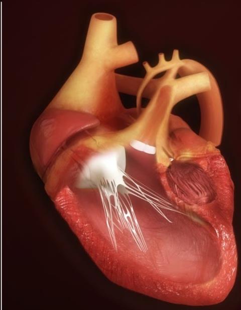 Sindrome del cuore sinistro ipoplastico: cause, sintomi e trattamento