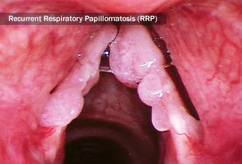 Laryngeale papillomatose: basisproblemen van de ziekte