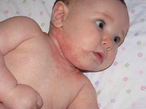 Soja-allergie: wat u moet weten