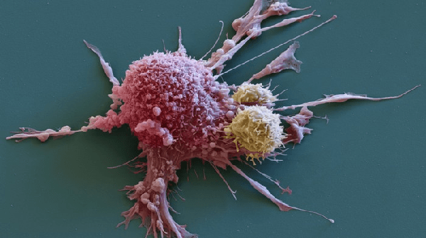 มะเร็งต่อมไขมัน: เนื้องอกที่เปลือกตาถึงตาย