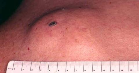 Epidermoid cyst: The most common type of cyst in the skin