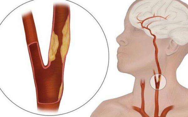 Artere: vase de sânge care transportă nutrienți către organism