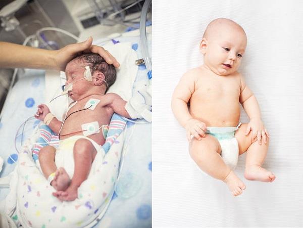 Cum să îngrijești și să hrănești bebelușii prematuri?