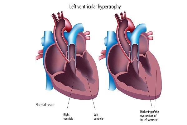 Hipertrofia ventricular izquierda: Causas, síntomas, diagnóstico y tratamiento