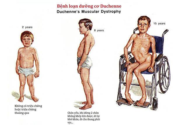 Duchenne muscular dystrophy: dangerous hereditary muscular dystrophy