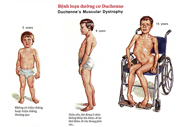 Distrofia muscular de Duchenne: peligrosa distrofia muscular hereditaria