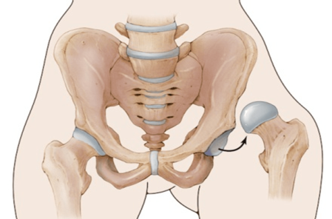 Dislocation of the hip: Causes, symptoms, treatment methods