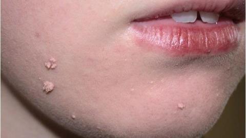 Infection au VPH dans certaines maladies bucco-dentaires